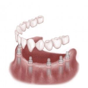 Category Image for Complete Teeth Replacement