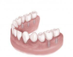Category Image for Multiple Dental Implants