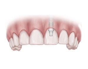 Drawing Showing Implant-Supported Crown