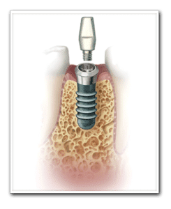 Drawing Showing Abutment Attachment Copy