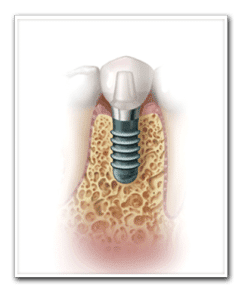 Drawing Showing Replacement Teeth Copy Drawing Showing Replacement Teeth Copy