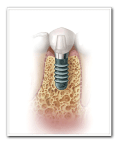 Drawing Showing Replacement Teeth Copy