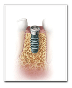 Drawing of Implant Placement Copy