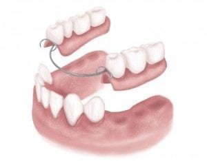 Drawing of Lower Jaw Showing Partial Denture Placement