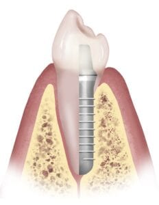 Dental Implant vs Real Tooth Comparison