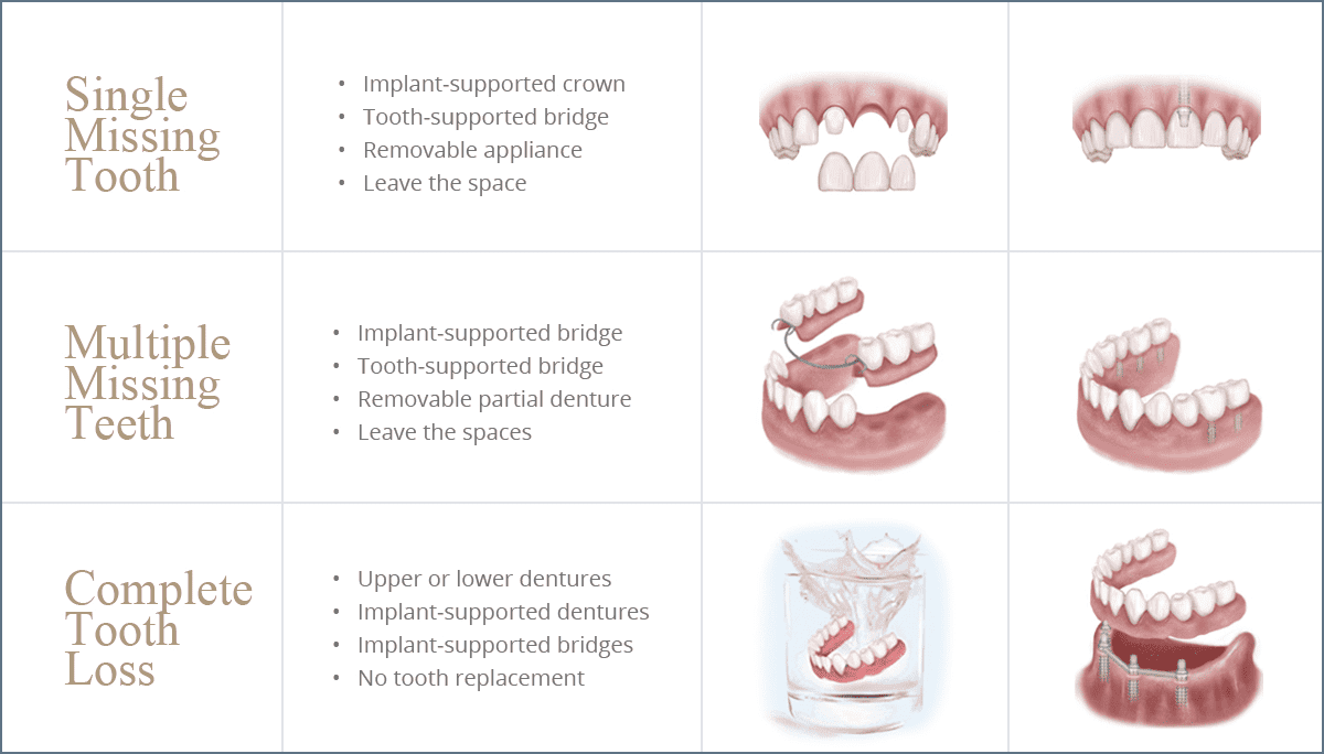Illustrations and Comparisons of Single Implant, Multiple Teeth Implants, and Complete Upper and Lower denture/implants