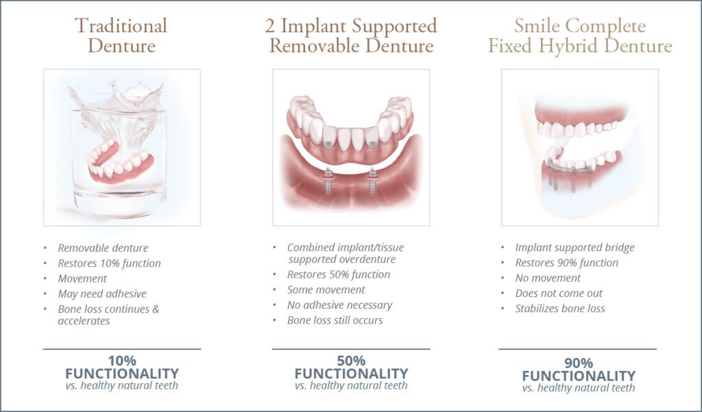 Drawings of traditional dentures, 2-implant supported removable denture, and smile complete fixed hybrid denture. 